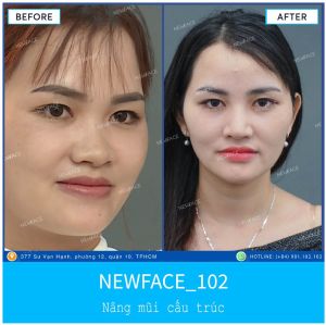 Hình ảnh nâng mũi trước sau Bs Trần Phương - Ca 102