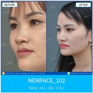 Hình ảnh nâng mũi trước sau Bs Trần Phương - Ca 102