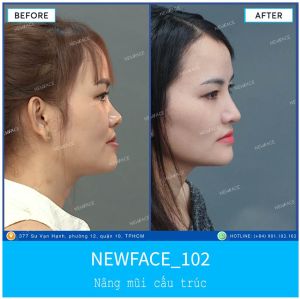 Hình ảnh nâng mũi trước sau Bs Trần Phương - Ca 102