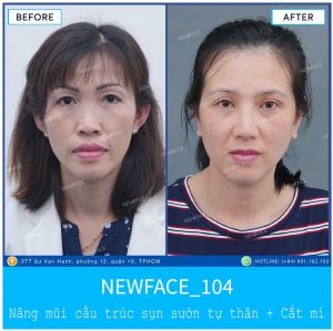 Hình ảnh nâng mũi trước sau Bs Trần Phương - Ca 104