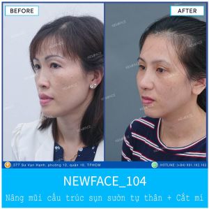 Hình ảnh nâng mũi trước sau Bs Trần Phương - Ca 104
