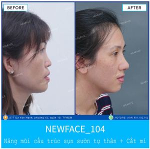 Hình ảnh nâng mũi trước sau Bs Trần Phương - Ca 104