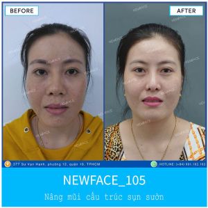 Hình ảnh nâng mũi trước sau Bs Trần Phương - Ca 105