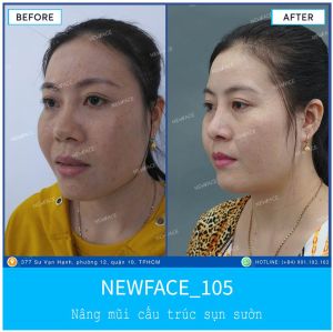 Hình ảnh nâng mũi trước sau Bs Trần Phương - Ca 105