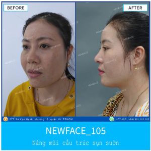 Hình ảnh nâng mũi trước sau Bs Trần Phương - Ca 105