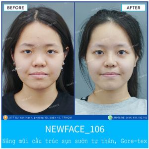 Hình ảnh nâng mũi trước sau Bs Trần Phương - Ca 106