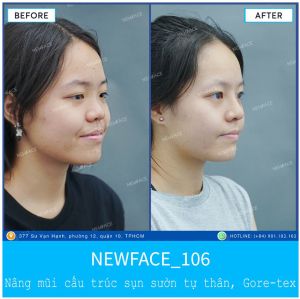 Hình ảnh nâng mũi trước sau Bs Trần Phương - Ca 106