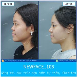 Hình ảnh nâng mũi trước sau Bs Trần Phương - Ca 106