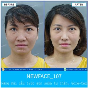 Hình ảnh nâng mũi trước sau Bs Trần Phương - Ca 107