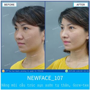 Hình ảnh nâng mũi trước sau Bs Trần Phương - Ca 107