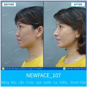 Hình ảnh nâng mũi trước sau Bs Trần Phương - Ca 107