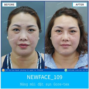 Hình ảnh nâng mũi trước sau Bs Trần Phương - Ca 109