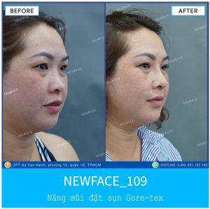 Hình ảnh nâng mũi trước sau Bs Trần Phương - Ca 109