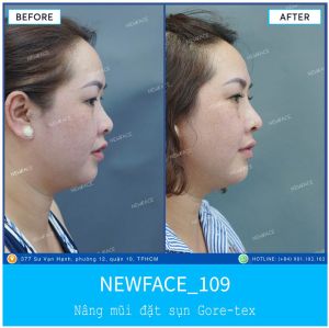 Hình ảnh nâng mũi trước sau Bs Trần Phương - Ca 109