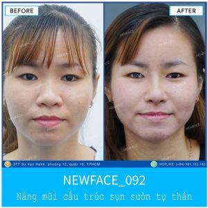 Hình ảnh nâng mũi trước sau Bs Trần Phương - Ca 92