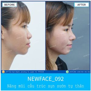 Hình ảnh nâng mũi trước sau Bs Trần Phương - Ca 92