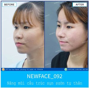 Hình ảnh nâng mũi trước sau Bs Trần Phương - Ca 92