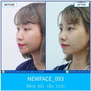 Hình ảnh nâng mũi trước sau Bs Trần Phương - Ca 93