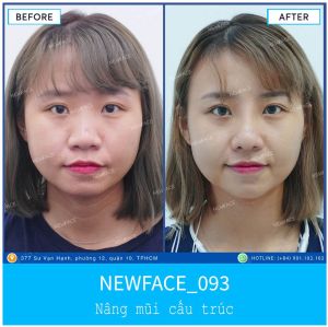 Hình ảnh nâng mũi trước sau Bs Trần Phương - Ca 93