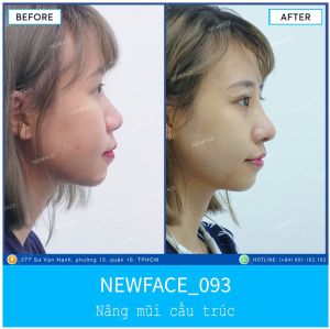 Hình ảnh nâng mũi trước sau Bs Trần Phương - Ca 93