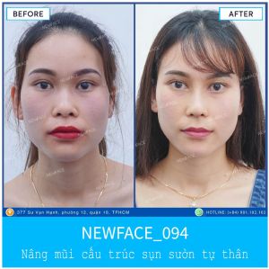 Hình ảnh nâng mũi trước sau Bs Trần Phương - Ca 94