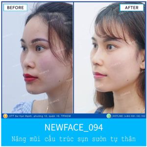 Hình ảnh nâng mũi trước sau Bs Trần Phương - Ca 94