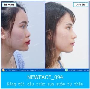 Hình ảnh nâng mũi trước sau Bs Trần Phương - Ca 94
