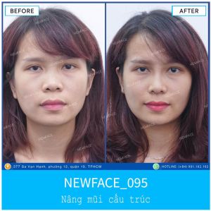 Hình ảnh nâng mũi trước sau Bs Trần Phương - Ca 95