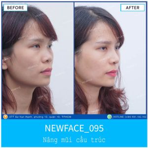 Hình ảnh nâng mũi trước sau Bs Trần Phương - Ca 95