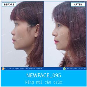 Hình ảnh nâng mũi trước sau Bs Trần Phương - Ca 95
