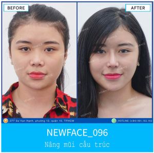 Hình ảnh nâng mũi trước sau Bs Trần Phương - Ca 96
