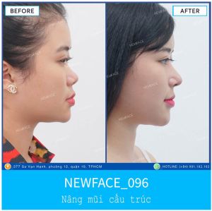 Hình ảnh nâng mũi trước sau Bs Trần Phương - Ca 96