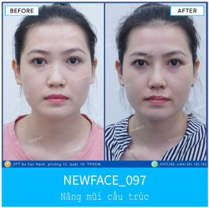 Hình ảnh nâng mũi trước sau Bs Trần Phương - Ca 97