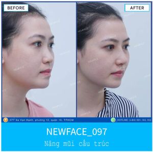 Hình ảnh nâng mũi trước sau Bs Trần Phương - Ca 97