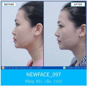 Hình ảnh nâng mũi trước sau Bs Trần Phương - Ca 97