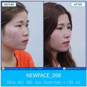 Hình ảnh nâng mũi trước sau Bs Trần Phương - Ca 98