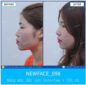 Hình ảnh nâng mũi trước sau Bs Trần Phương - Ca 98