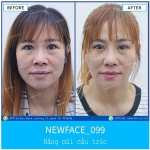 Hình ảnh nâng mũi trước sau Bs Trần Phương - Ca 99