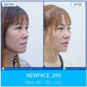 Hình ảnh nâng mũi trước sau Bs Trần Phương - Ca 99