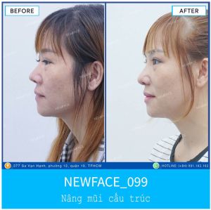 Hình ảnh nâng mũi trước sau Bs Trần Phương - Ca 99