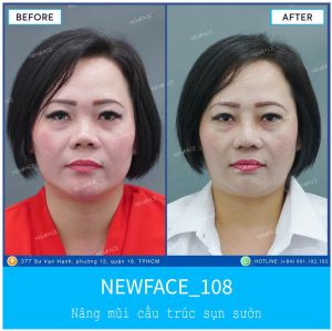 Hình ảnh nâng mũi trước sau Bs Trần Phương - Ca 108