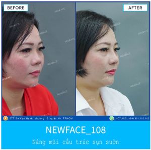 Hình ảnh nâng mũi trước sau Bs Trần Phương - Ca 108