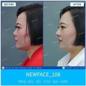 Hình ảnh nâng mũi trước sau Bs Trần Phương - Ca 108