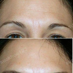 Hình ảnh tiêm Botox trước sau Dr Tâm – ca 1