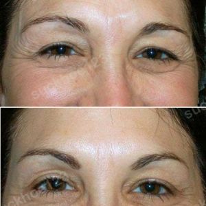 Hình ảnh tiêm Botox trước sau Dr Tâm – ca 1