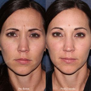 Hình ảnh tiêm Botox trước sau Dr Tâm – ca 10