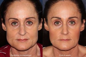 Hình ảnh tiêm Botox trước sau Dr Tâm – ca 11