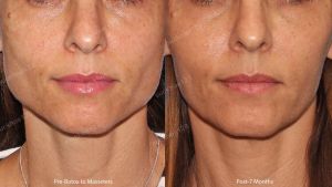 Hình ảnh tiêm Botox trước sau Dr Tâm – ca 12