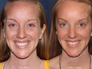 Hình ảnh tiêm Botox trước sau Dr Tâm – ca 13