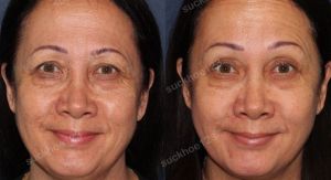 Hình ảnh tiêm Botox trước sau Dr Tâm – ca 14